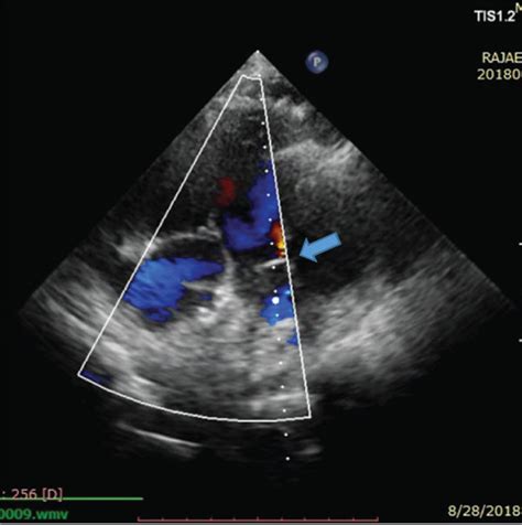 Follow Up Echocardiography Indicating The Proper Position Of The Afr