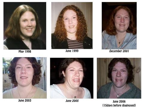 living  acromegaly  symptom       patient