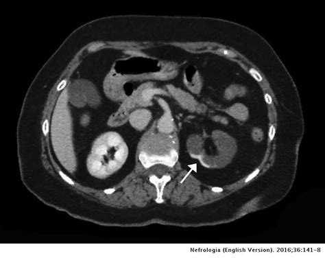 Acute Renal Infarction Clinical Characteristics And Prognostic Factors