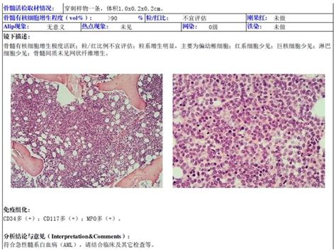 急性髓系白血病伴cebpa双等位基因突变1例分子诊断检验视界检验视界网