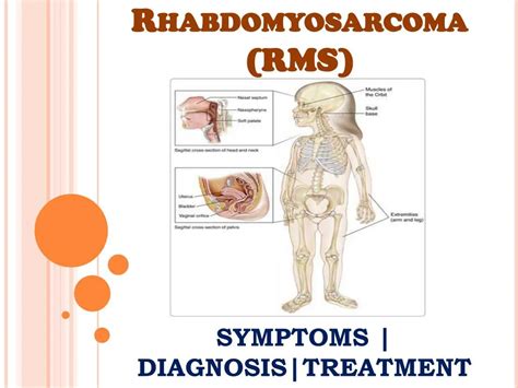 PPT - Rhabdomyosarcoma (RMS): Information on symptoms, diagnosis and treatment PowerPoint ...