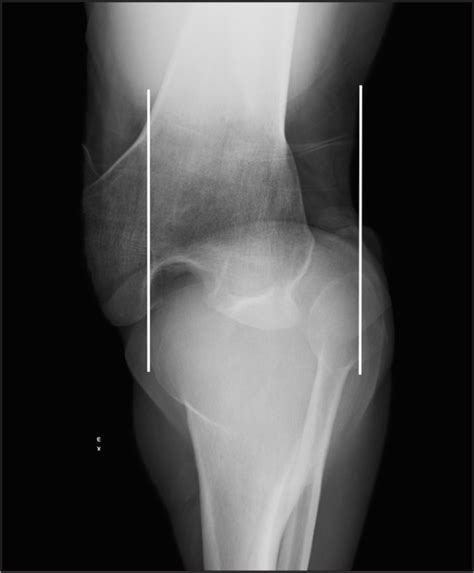 Image Diagnosis Knee Dislocation The Permanente Journal