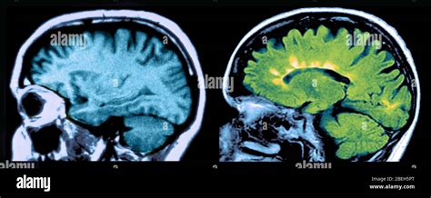 Ms Brain Mri With Contrast