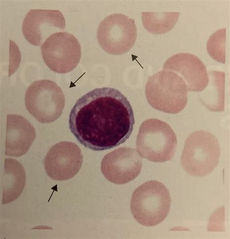 ASCP Hematology Test 3 Atlas Pictures Flashcards Quizlet