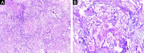 Invasive Clear Cell Variant Of Squamous Cell Carcinoma Mimicking