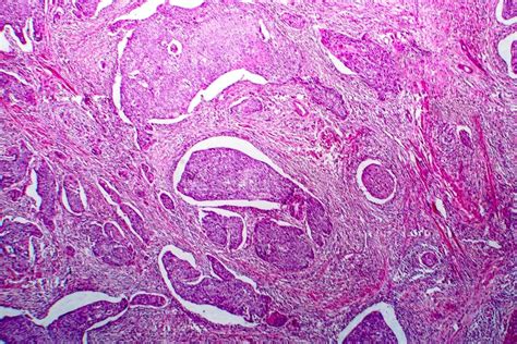 Carcinoma De C Lulas Escamosas De La Micrograf A De La Luz Del Tero