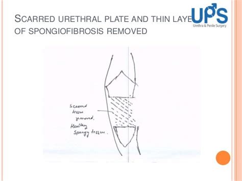 Urethroplasty Treatment