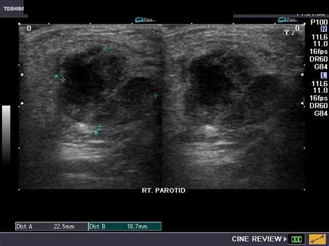 Submandibular Abscess Ultrasound