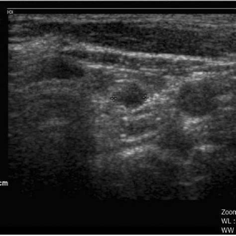 Ultrasonographic image of N1a. Lymph node without fatty hilum in level ...