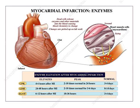 Heart Enzymes During Heart Attack Illustration Stock Image C059 3222 Science Photo Library