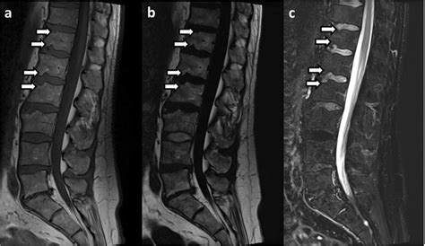 Illustration Of Schmorl Nodes Anterior Prolapse Of Intervertebral Disc