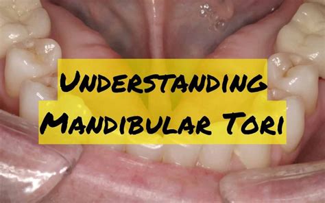 Understanding Mandibular Tori Causes Treatment And Concerns