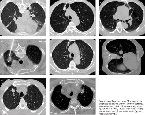 Figure 1 From Safety And Diagnostic Accuracy Of Percutaneous Ct Guided