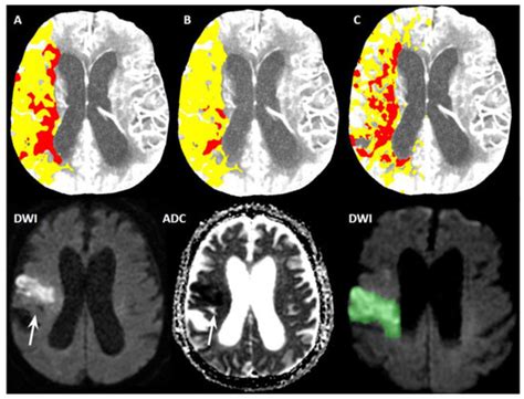 Diagnostics Free Full Text Ct Brain Perfusion In The Prediction Of