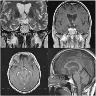 Preoperative Mri Scans Show X Cm Large Cystic Craniopharyngioma