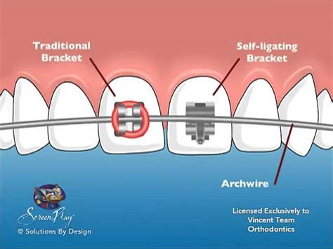 Vincent Team Orthodontics Self Ligating Braces Y PT Cobra Dental