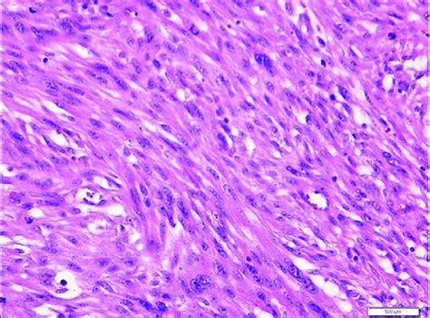 Histopathology Evaluation Shows Spindle Cells With Cigar Shaped Nuclei