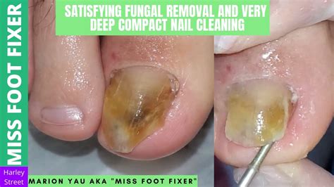 Satisfying Fungal Removal And Very Deep Compact Nail Cleaning By Miss