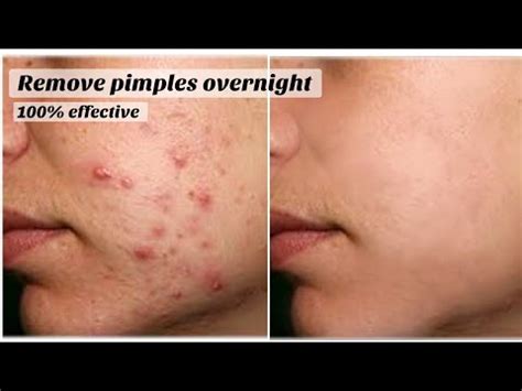 Remove Pimples Overnight Result Get Rid Of Pimples Overnight