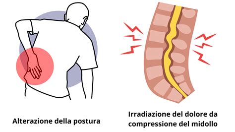 Tutto Quello Che Devi Sapere Su Cosa Non Fare Con La Spondilolistesi