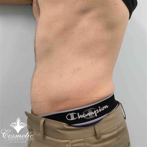 Emsculpt Muscle Toning And Fat Reduction Treatments In Mclean Va