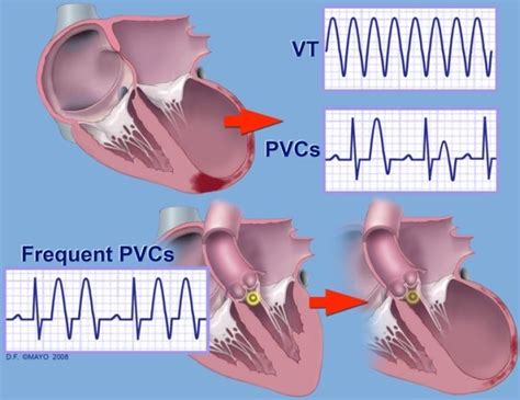 Premature Ventricular Contractions Pvcs Ablation Rhythm And Cardiac