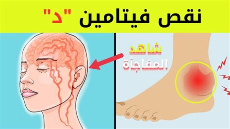 10 علامات تحذيرية أنك تعاني من نقص فيتامين د لا تهمل هذه الأعراض