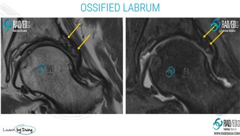 Hip Labrum Ossification Mri Labral Abnormalities More Than Just Tears