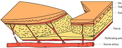 Schematic diagram of the V-Y advancement flap. The subcutaneous flap... | Download Scientific ...