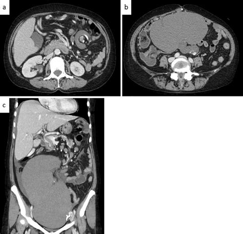 Figure Abdominal Enhanced Computed Tomography Ct Axial And Coronal