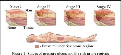 Figure 1 From A Novel System To Tackle Hospital Acquired Pressure Ulcers Semantic Scholar