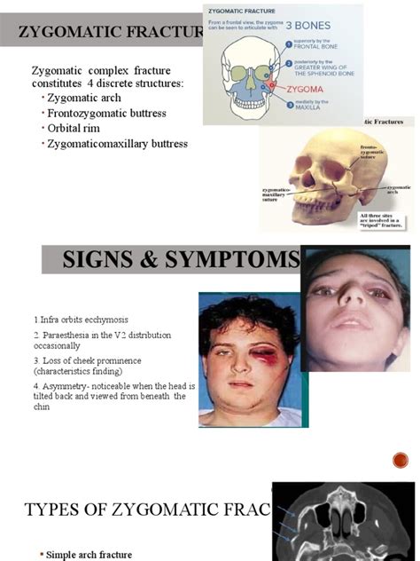 Zygomatic FX | PDF | Human Anatomy | Human Head And Neck