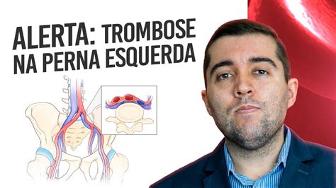 Entenda A Rela O Entre Trombose Na Perna Esquerda E A S Ndrome De May