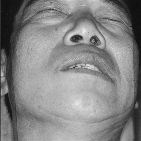 Initial View Of Facial Palsy Download Scientific Diagram