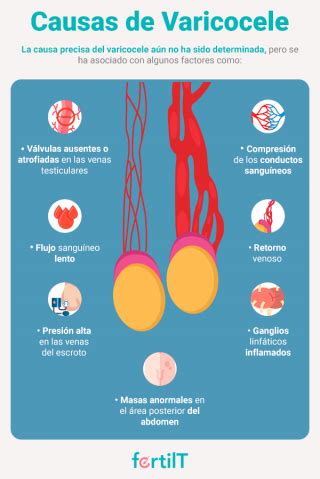 Varicocele qué es síntomas causas e infertilidad