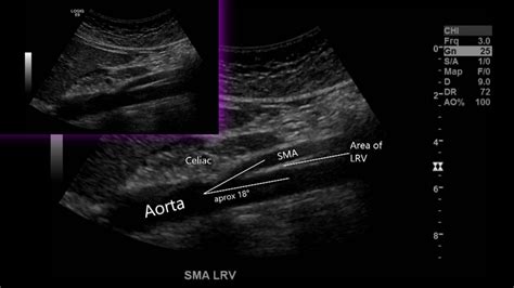 Nutcracker Phenomenon Syndrome Sonographic Tendencies