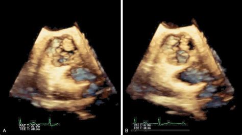 Aortic Stenosis Clinical Presentation Disease Stages And Timing Of