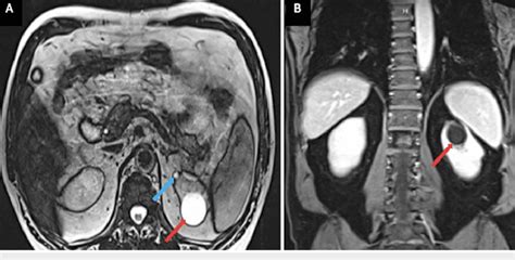 MRI of the abdomen MRI of the abdomen in cross-sectional (Panel A) and ...