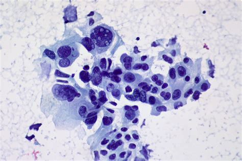 Non Small Cell Carcinoma Fna Image By Dr Ed Uthman Flickr