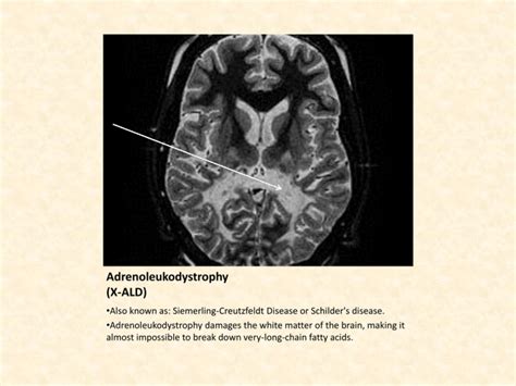 Adrenoleukodystrophy Ald