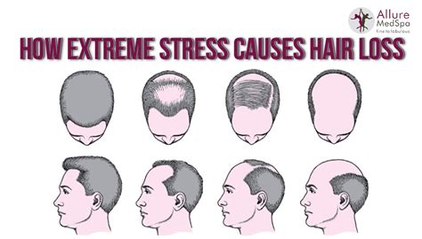 Visit To Learn How Stress Can Cause Hair Loss Allure MedSpa