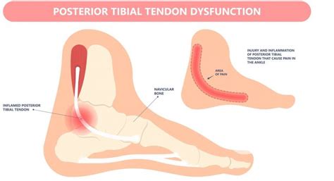 Posterior Tibial Tendon Dysfunction Treatment Straits Podiatry