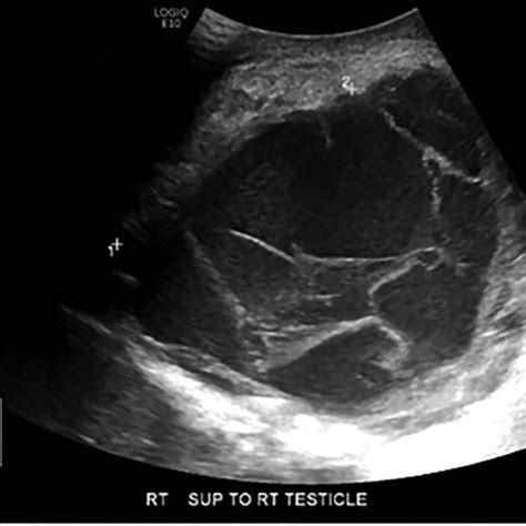 Scrotal Cyst Ultrasound