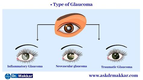 Glaucoms Intraocular Pressure Iop Homeopathic Treatement Glaucoma