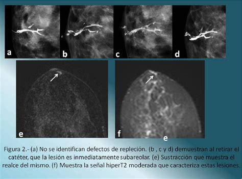 Figure From Utilidad De La Resonancia Magn Tica De Mama Para El