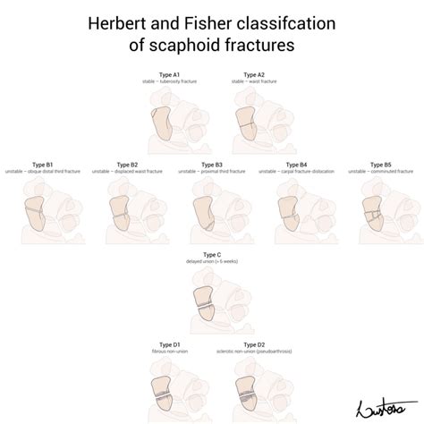 Scaphoid Fracture Classification