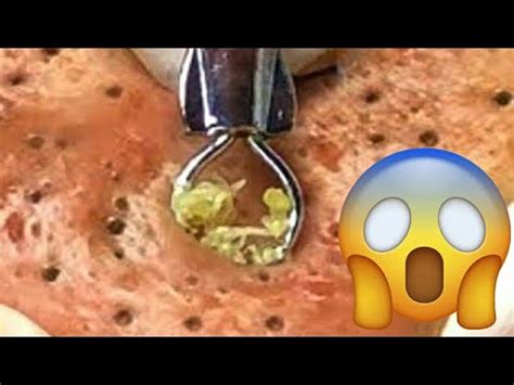 World Biggest Blackheads, Blackhead Removal. - YouTube