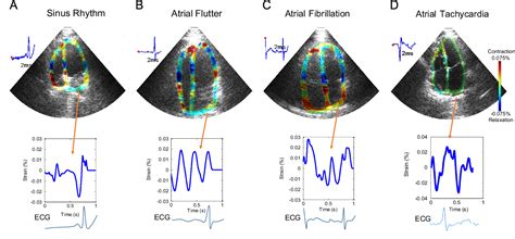 Figure From Assessing The Atrial Electromechanical Coupling During