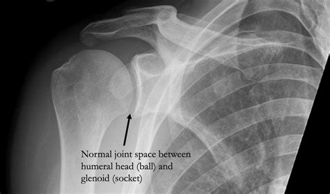 Shoulder Osteoarthritis — Jonathan Koscso, MD