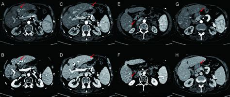 Abdominal Contrast Enhanced Computed Tomography AB Enlargement Of